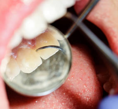 Gum-Disease-Symptoms