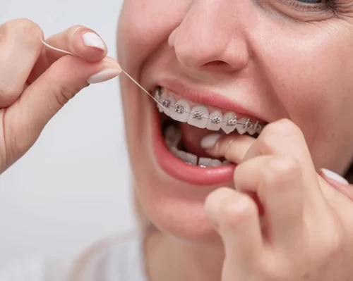dental-braces