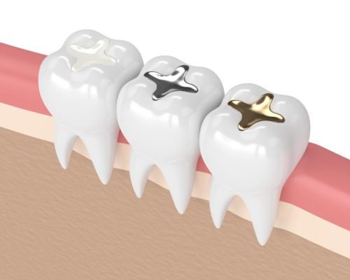 dental-filling