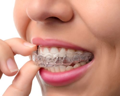 pros-and-cons-of-invisalign