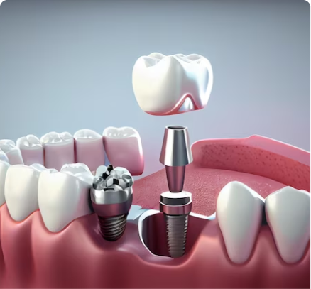 Dental-Implant Dental-Implant