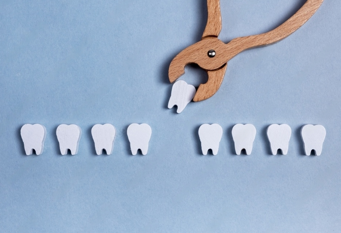 Detailed-Procedure-For-Wisdom-Tooth-Extraction-In-Whitefield Detailed-Procedure-For-Wisdom-Tooth-Extraction-In-Whitefield