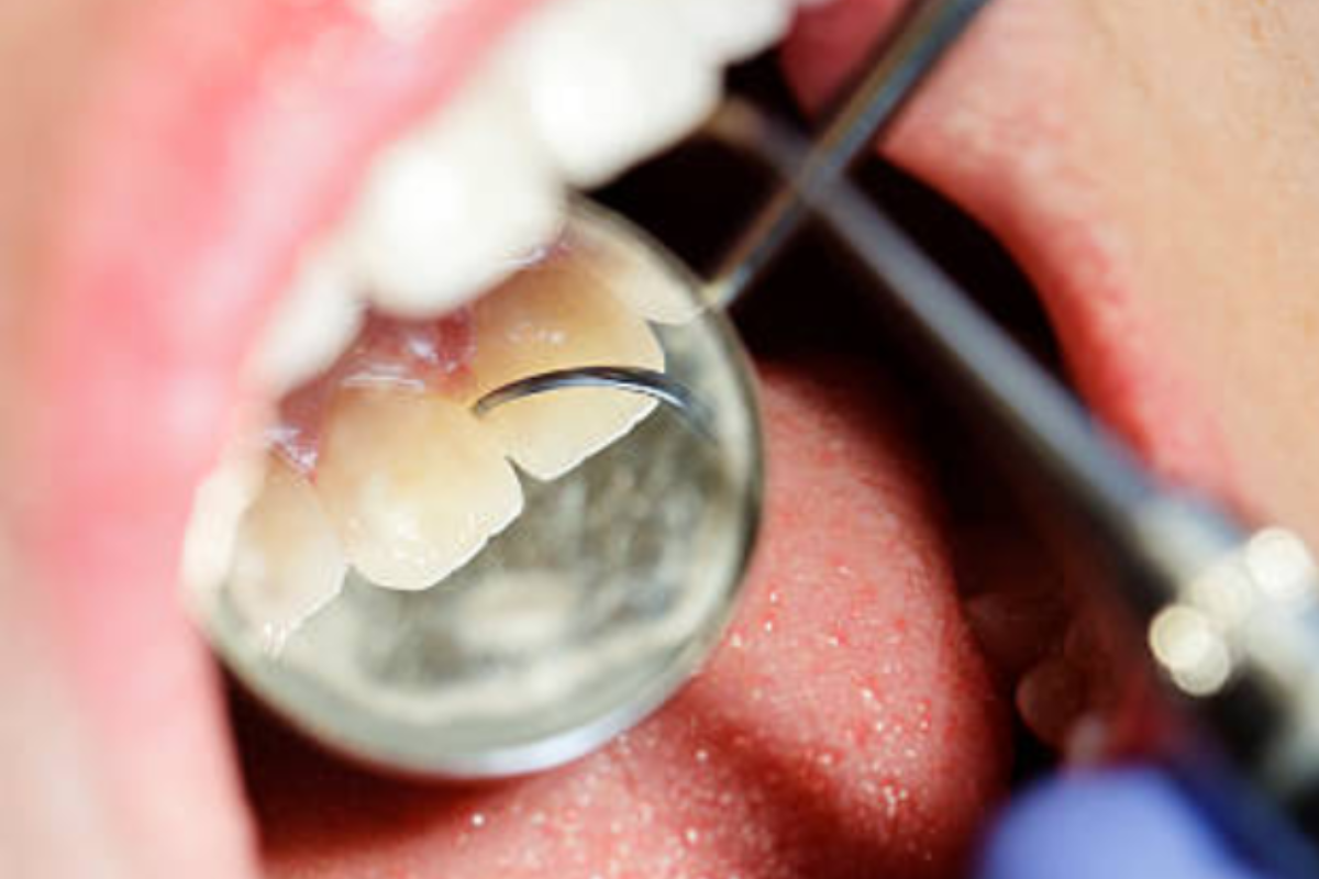 Gum-Disease-Symptoms Gum-Disease-Symptoms