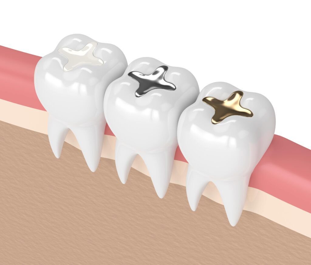 dental-filling dental-filling